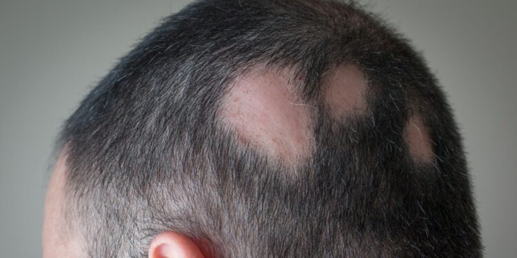 Historic Alopecia Treatment to be Launched on NHS in the UK