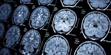 Study Identifies Leaky Blood Vessels as Potential Cause of Long COVID Brain Fog
