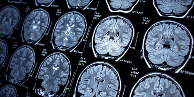 Study Identifies Leaky Blood Vessels as Potential Cause of Long COVID Brain Fog