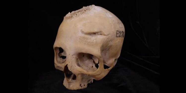 Remarkable Discovery: Surgical Attempts on Cancer by Ancient Egyptians Unveiled | Science & Health Insights