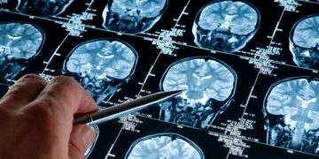 Insight Into Why Some Aging Brains Retain Cognitive Function Despite Alzheimer’s Pathology